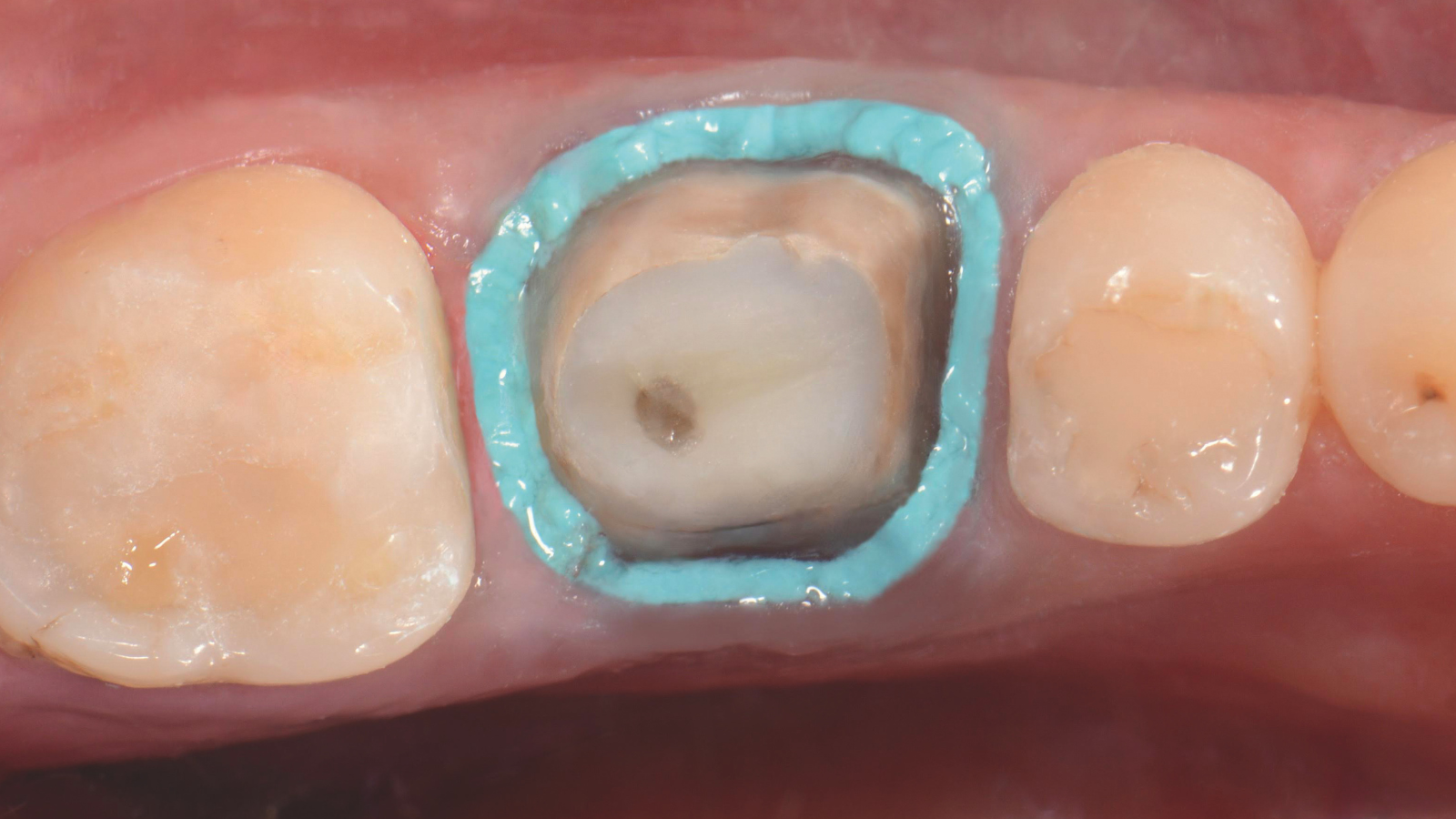 RetraXil 2
