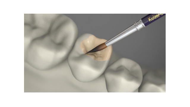 Fațetare fără metal