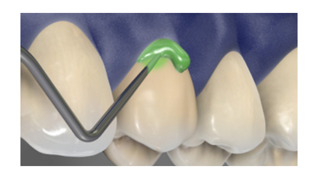Materiale de prevenție