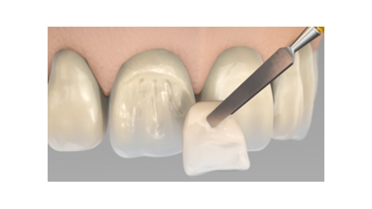 Compozite pentru fațetare