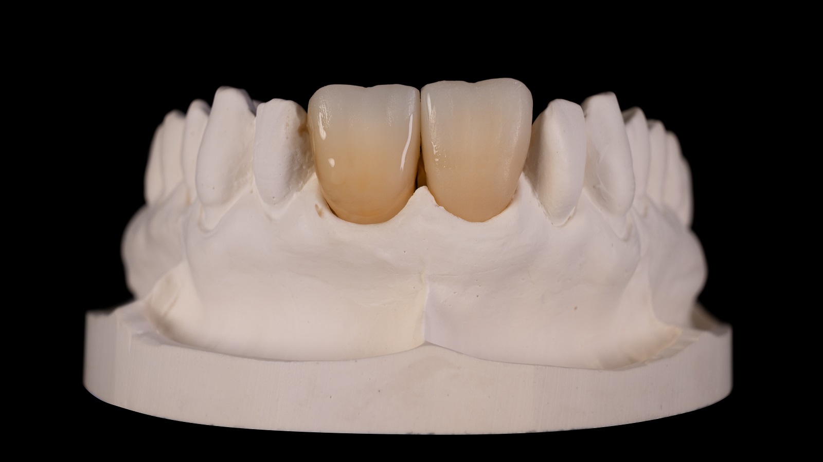 Intensificarea culorii în zona cervicală:
