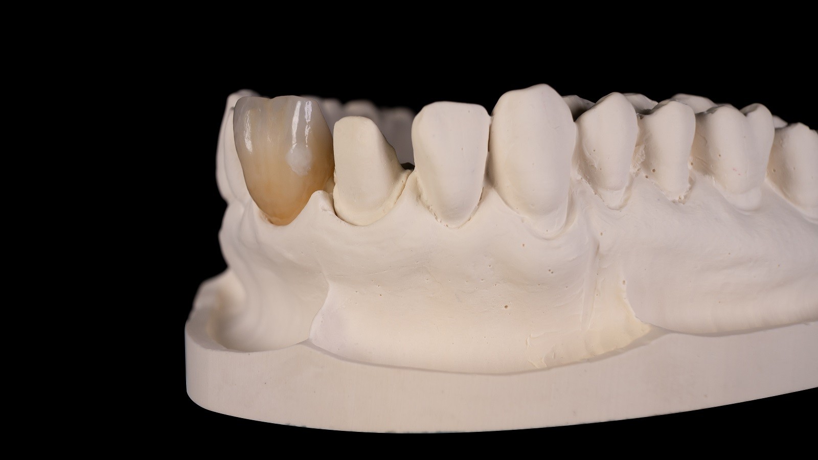 Final result of enamel lime spot