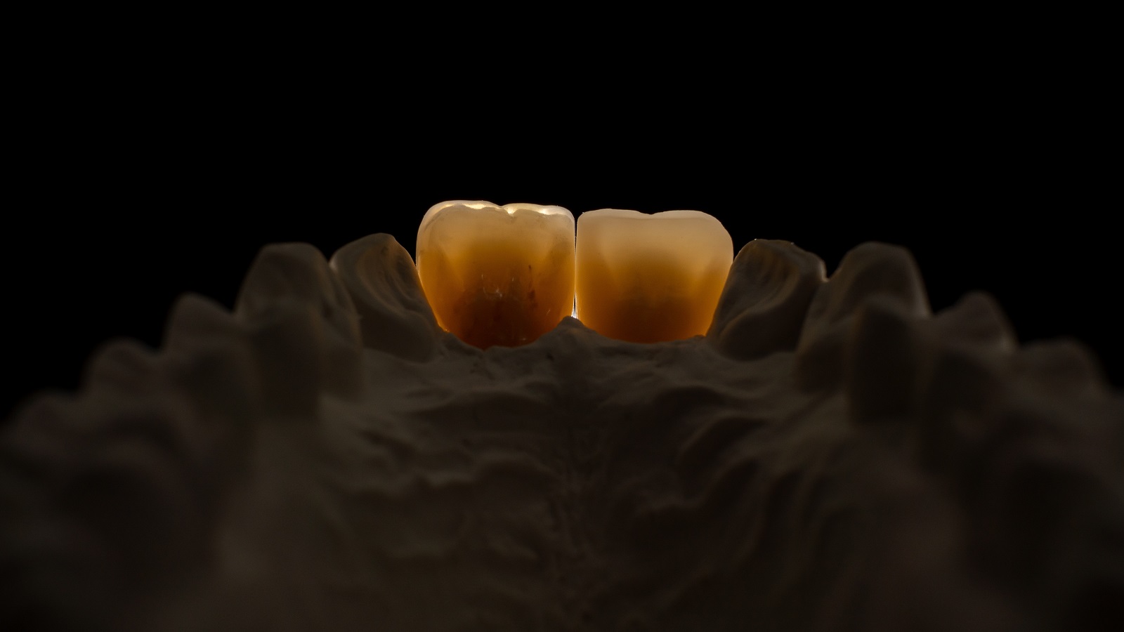 Rezultatul final în lumină transmisă – vedere palatinală