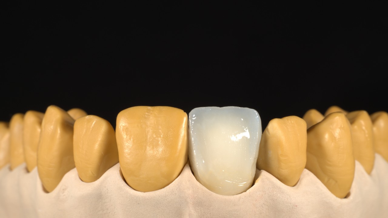 Image 3: Staining of cervical and incisal areas