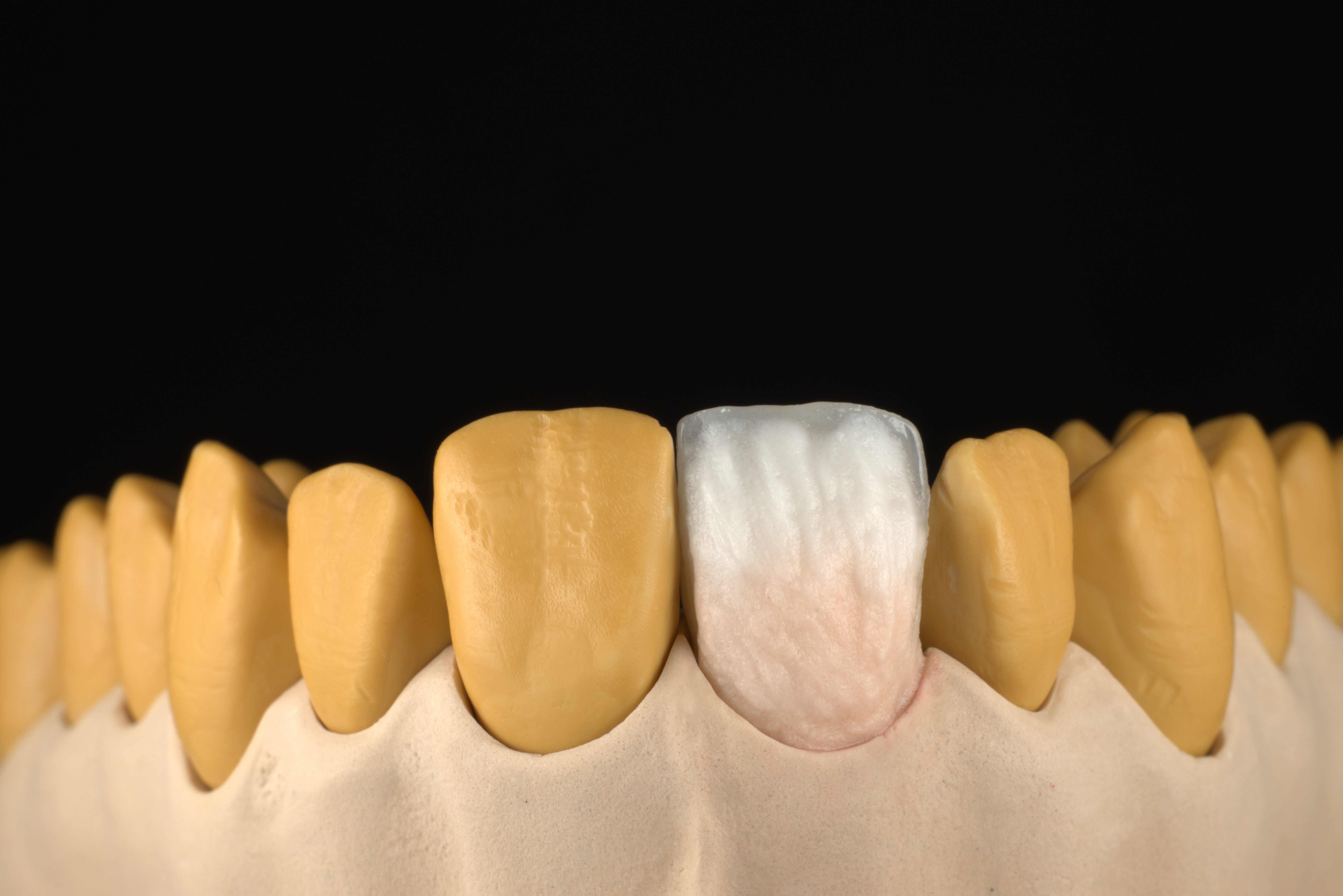 Image 4: Application of dentin and translucent materials 