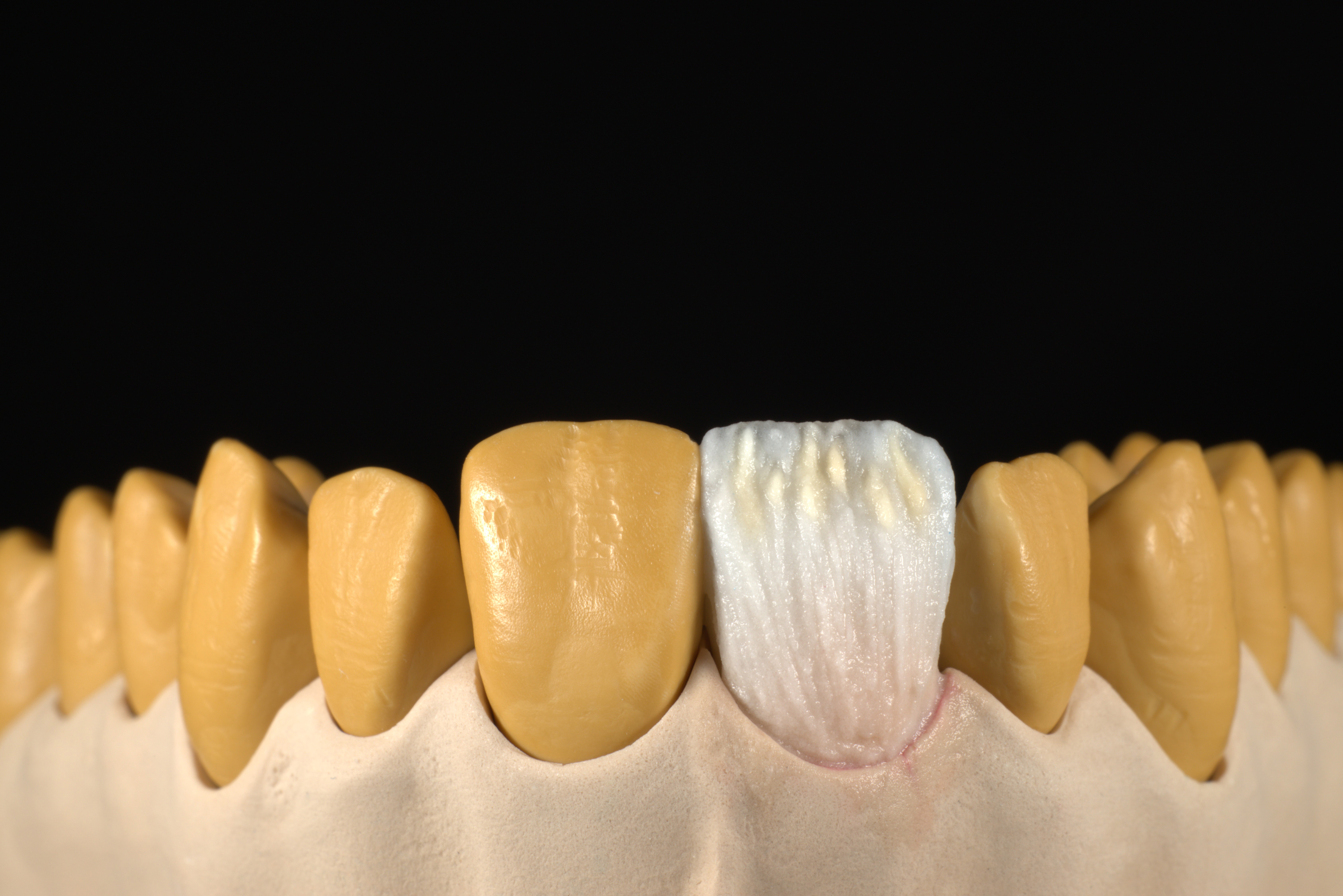 Image 5: Mamelons and approximal shaping. 